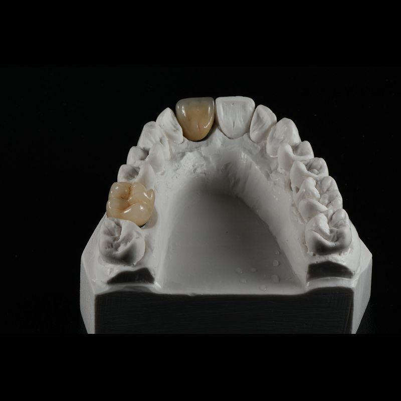 Dentists Cad Cam PFM Crown Ceramic Material Metal Foundation