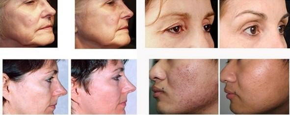 thermag before-after pics.jpg