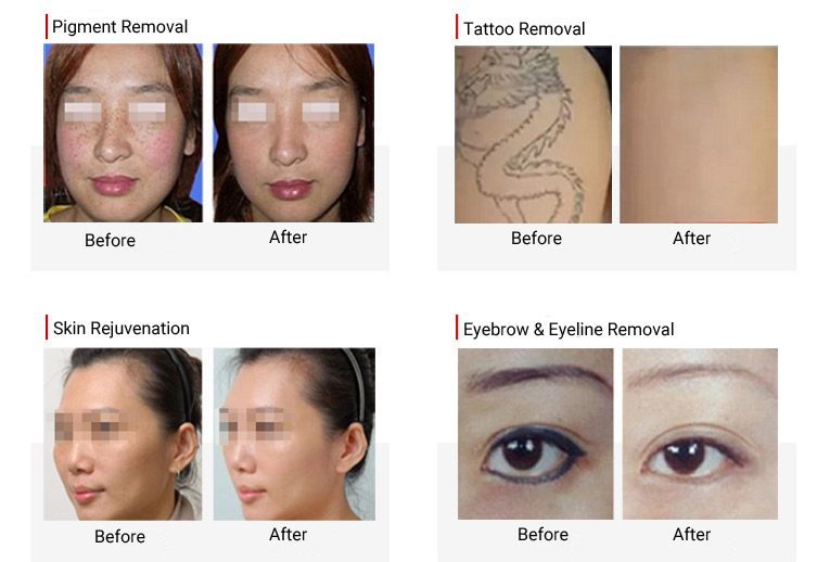 1064nm Laser Pigmentation Removal Machine , Yag Tattoo Removal Machine For Salon