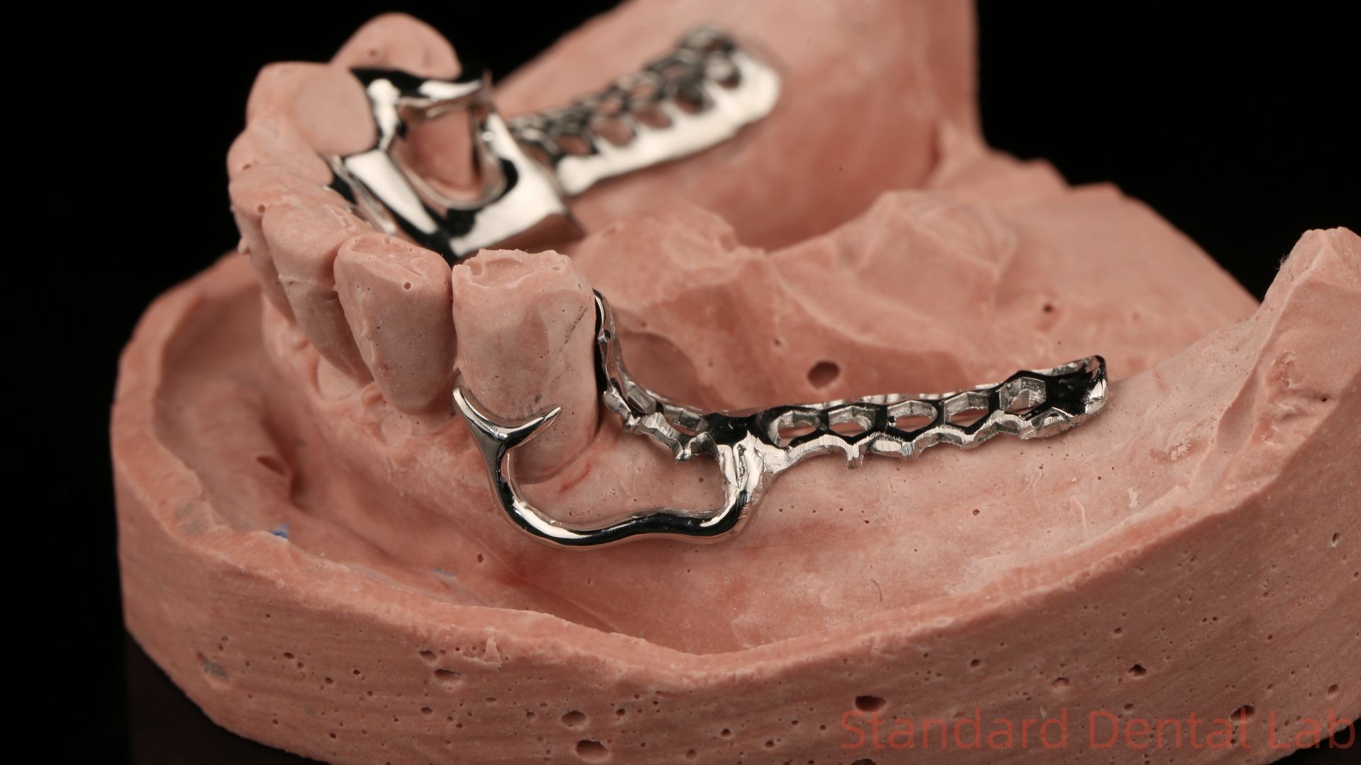 Cobalt Chrome Cast Metal Framework Partial Dentures With Lower Apron Design SDL Dental Lab