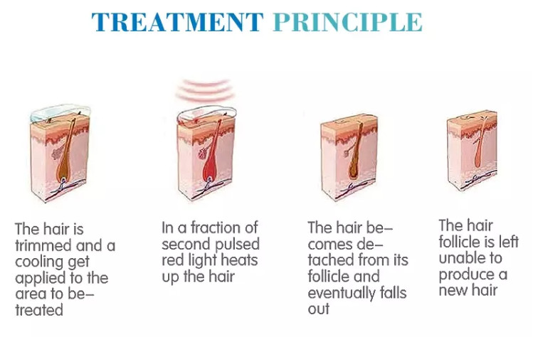 painless hair removal 808nm medical diode laser hair removal machine for sale