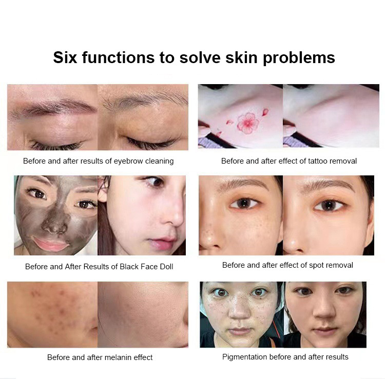 Carbon Peel Nd YAG Laser Machine Tattoo Removal For Skin Whitening