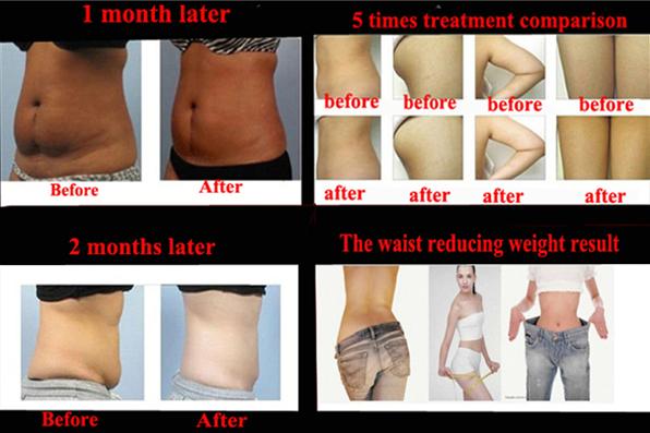5 handles Vacuum+Cryo, Cavitation and RF multifunctional Cryolipolysis slimming machine