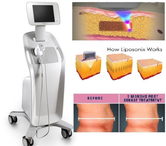 best selling products lipohifu liposonic hifu machine lipo machine