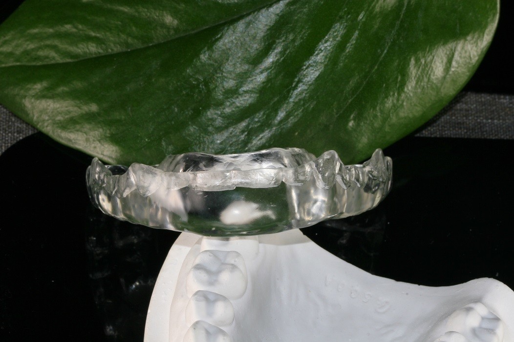 Custom Made Mandibular Arch Stablizing Bite Splint