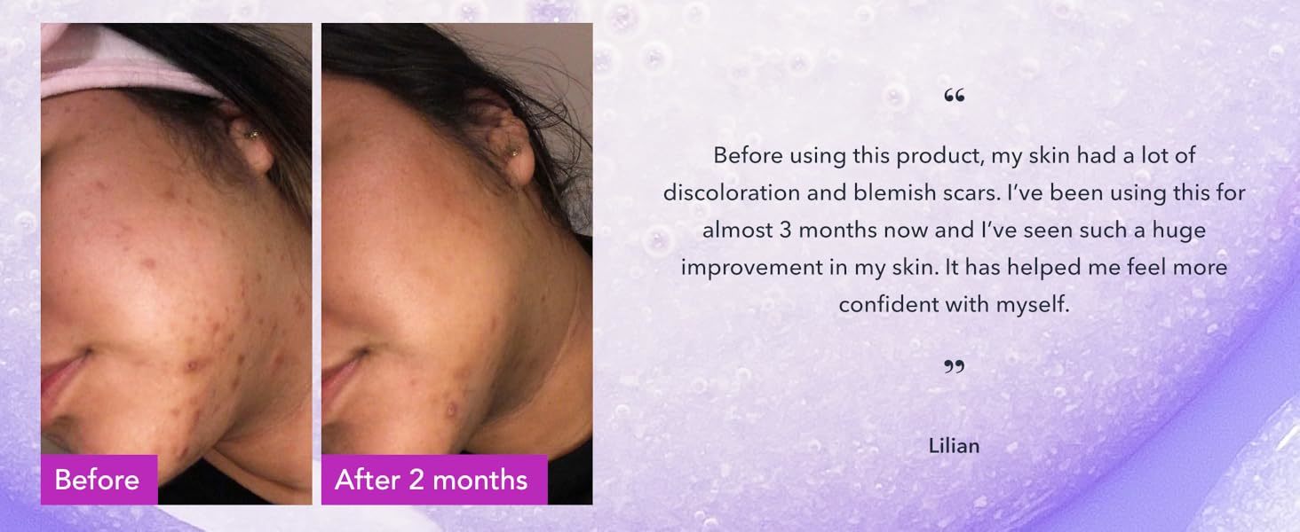 Alcohol Free Skin Molecules Discoloration Correcting Serum Tranexamic Acid Niacinamide For Dark Age Spots