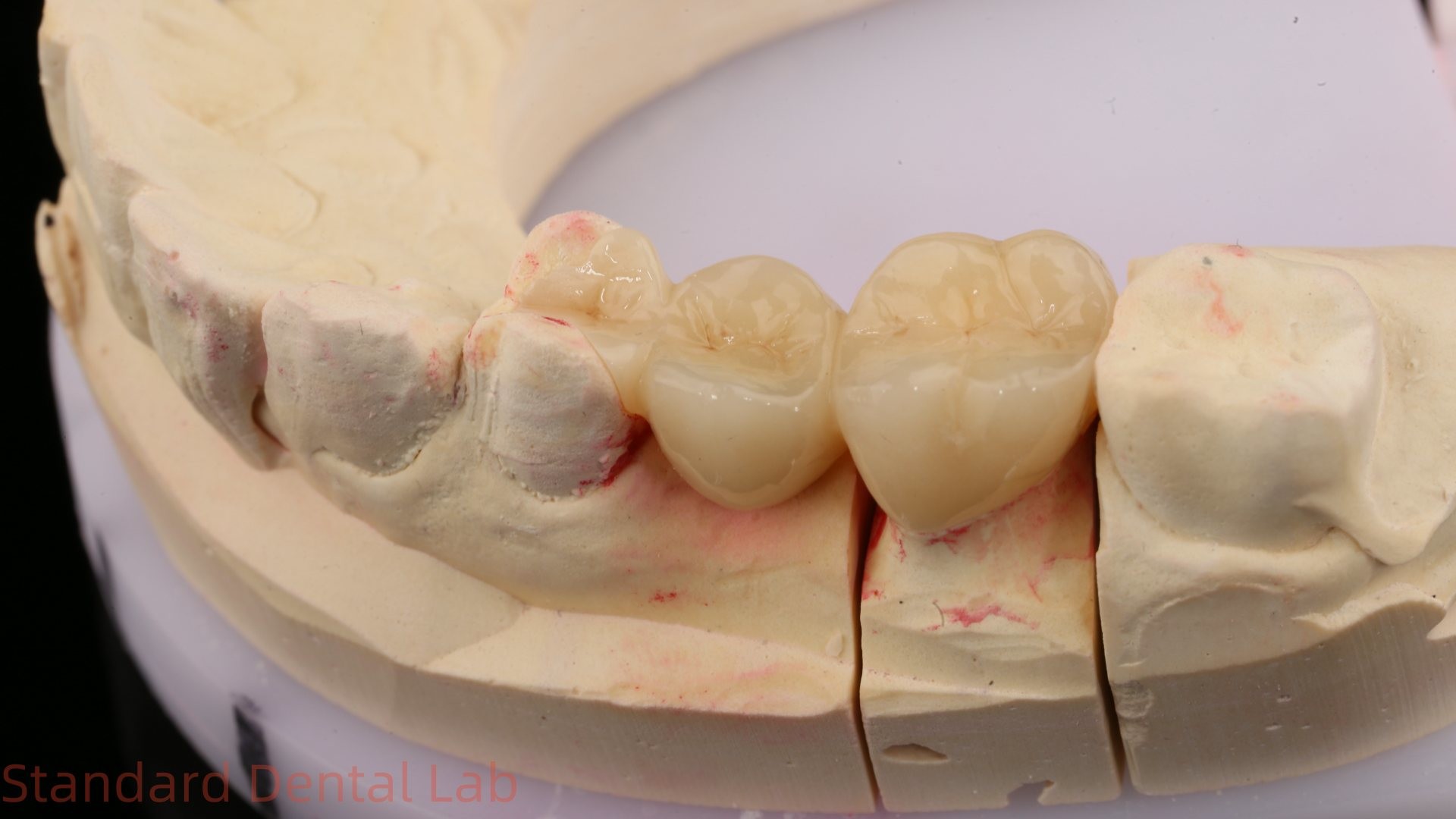 Dental Digital Full Zirconia Crown With 3D Print Model SDL Dental Lab Zirconia Onlay