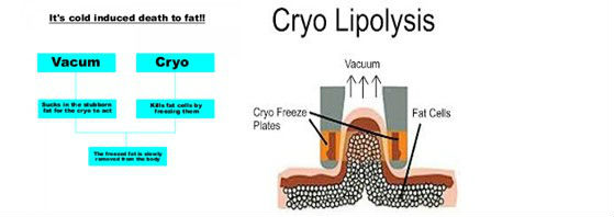 Innovative Coolsculpting Cryolipolysis Machine , Body Fat Freezing Machine No Surgy