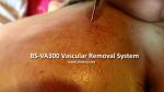 300 Watts Varicose Veins Laser Treatment Equipment