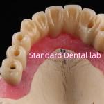 Zirconia Implant Bridge Screw Retained With Pink Gum Porcelain