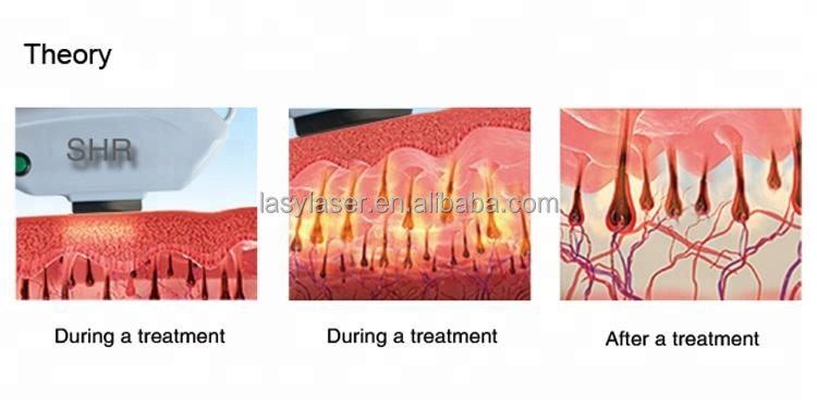 RF OPT IPL Laser Hair Removal Machine , SHR Laser Freckle Removal Machine