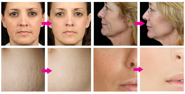 64 Pins Nano Microneedle Fractional RF Machine Acne Scar Removal