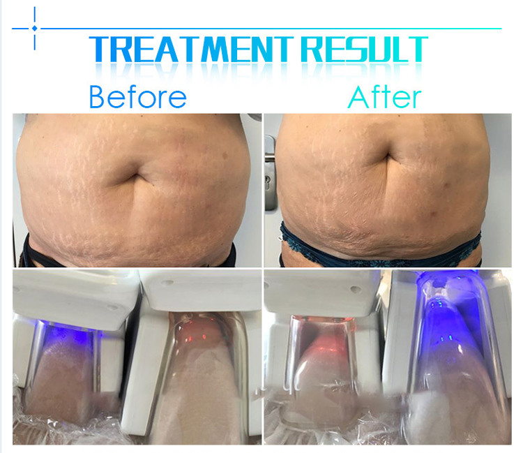 Vacuum therapy cellulite machine Fit Cryotherapy Slimming Machine With Different Handles
