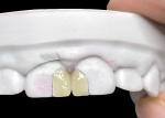 Cosmetic Dentistry EMAX Porcelain Veneers for Beautiful Dental Restorations