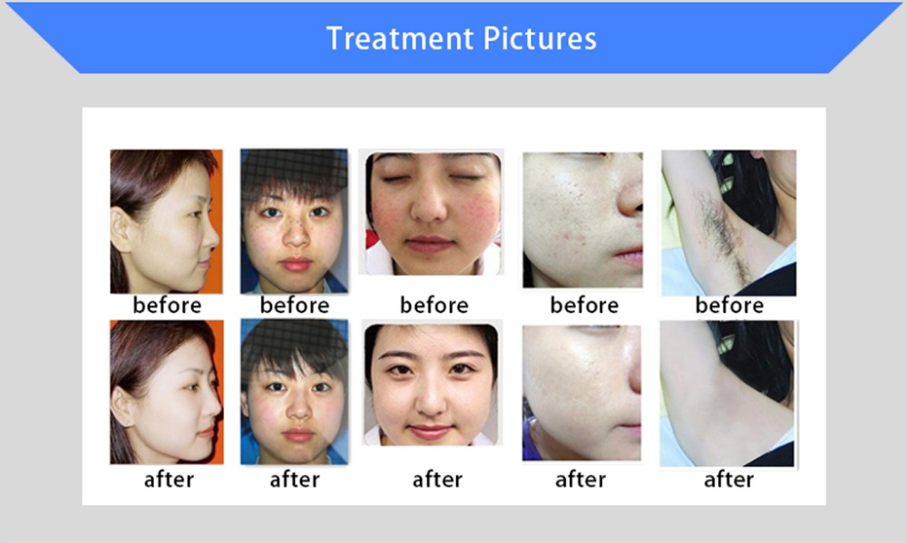 Two Handles Two Screen 2000W Permanent Painless Hair Removal And Skin Rejuvenation SHR IPL Machine