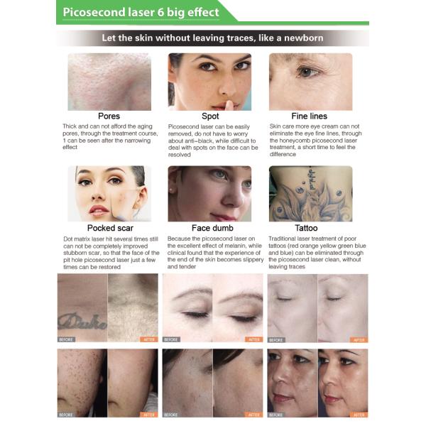 Professional CE Certified Picosecond Laser Carbon Peeling Tattoo Removal Machine