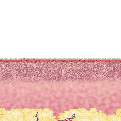 Clinic Carbon Dioxide fractional rf scars removal for intractable chloasmas, pigmentati