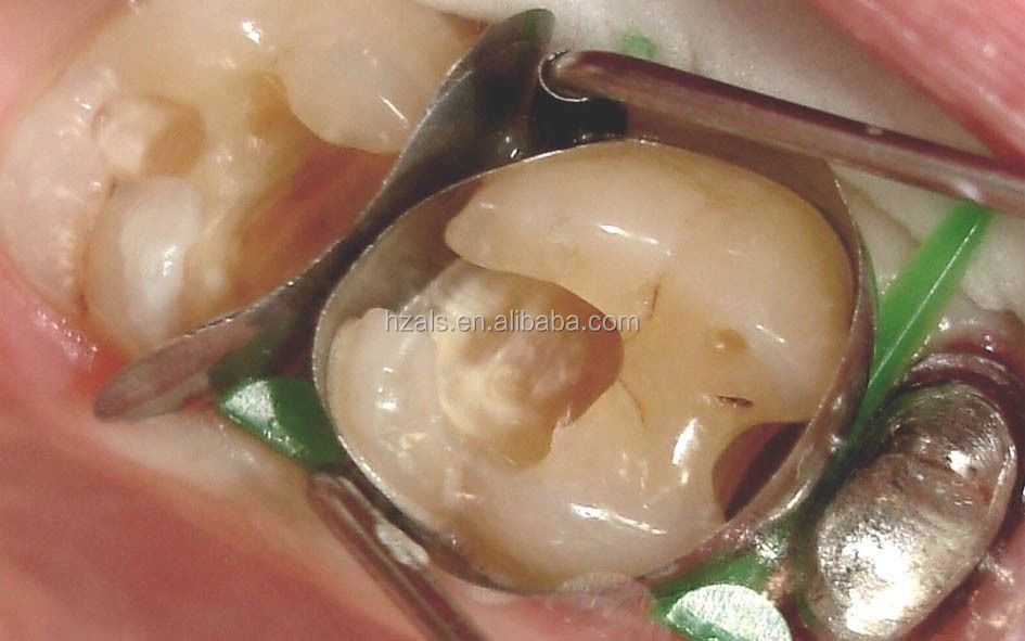12pcs/kit Dental Restoration Materials Twin Anterior Matrices no.1.523/1.533 TOR VM Shelf Life 2 years MFDS Safety Standard