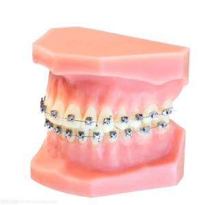 China Dental Braces Fixed Orthodontic Appliances Upgrade Soft Wire Brackets wholesale