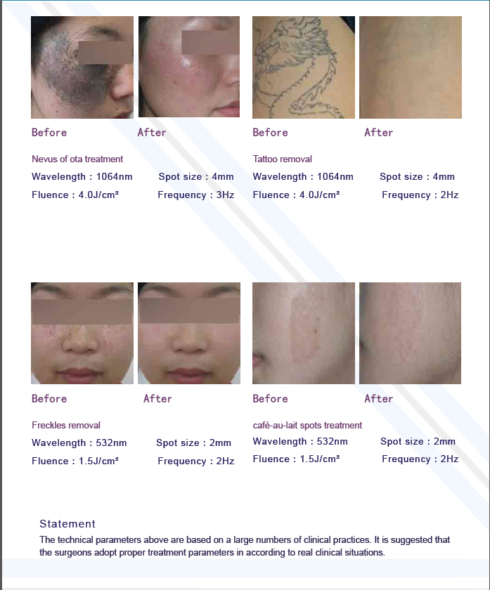 Beijing Sincoheren Updated Q Switched Nd yag laser factory 1064nm 532nm Melasama