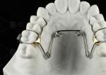 Children And Adolescents Quad Helix Appliance Orthodontics Stainless Steel