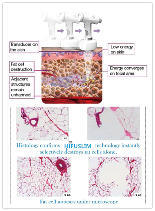 Supersonic High Intensity Focused Ultrasound beauty slim machine with bigger filter