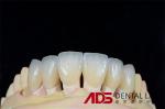 Dental Porcelain Feldspathic Veneers For Teeth Custom Shaped