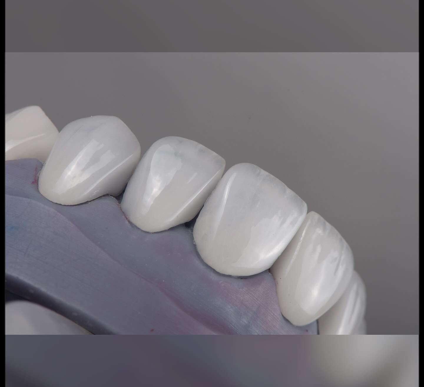 Natural looking Emax Veneers Crown Biocompatibility Bleaching Shade with Minimal Preparation
