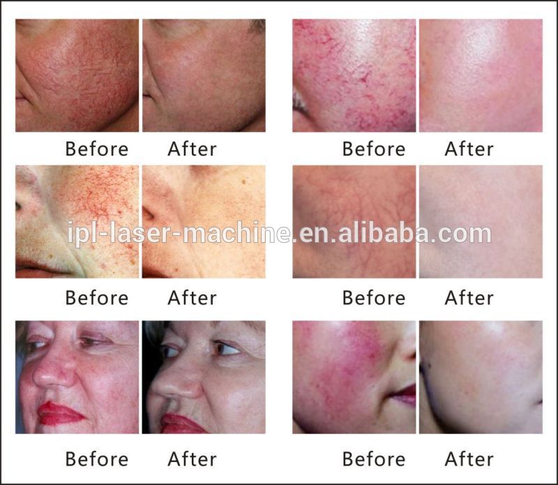 Super-High-Frequency-Spider-Vein-Removal-Machine-Rbs-Vascular (1).jpg