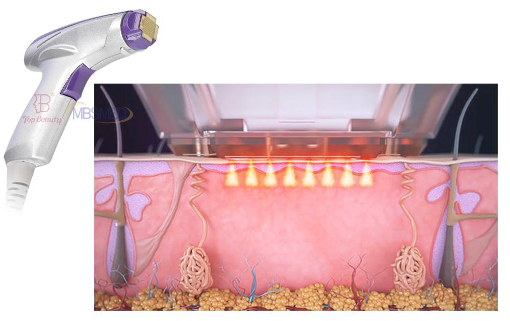 Portable Microneedling RF Fractional Radio Frequency Home Use Beauty Equipment For Salon Facelift Skin Tightening
