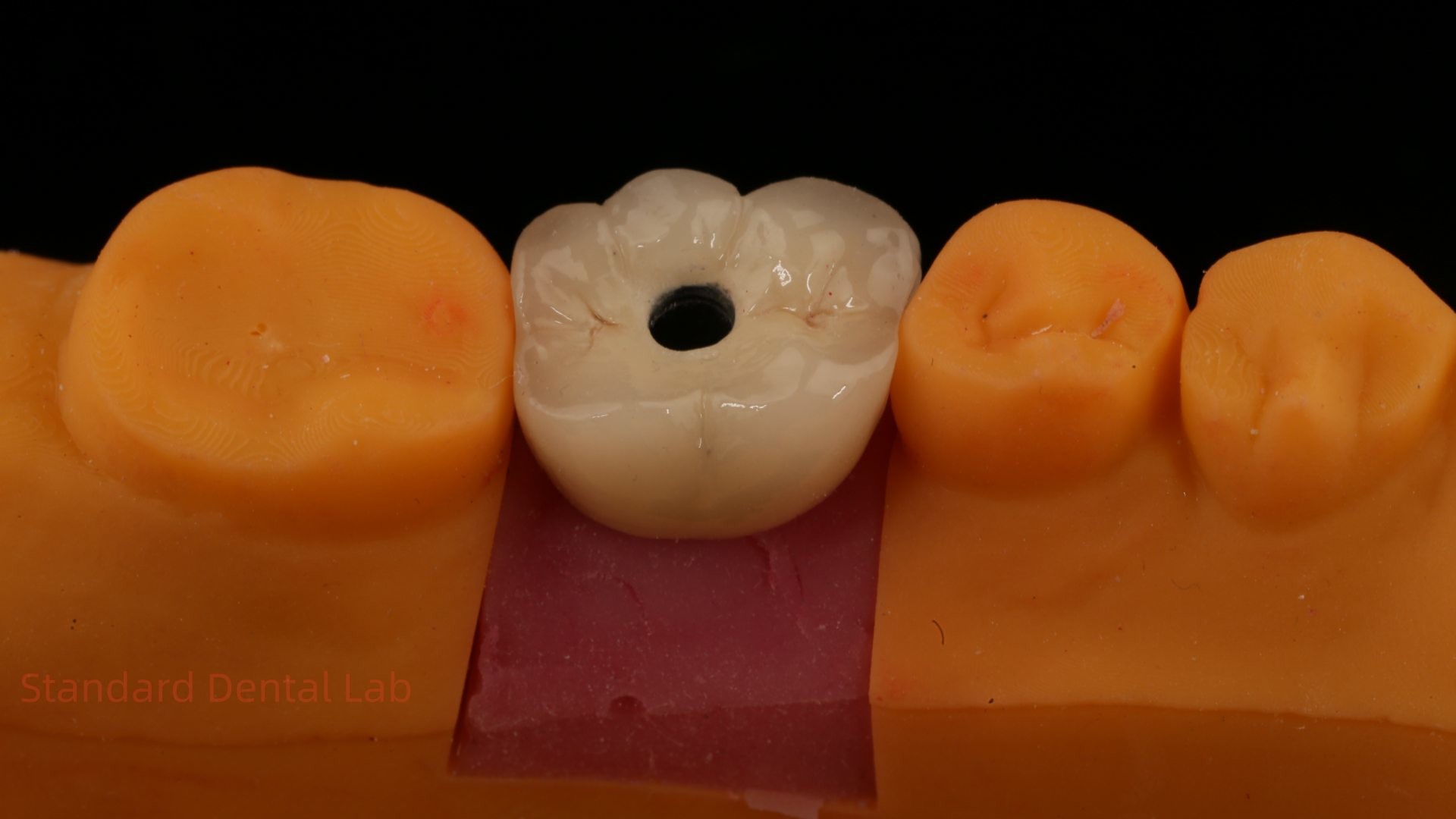 Screw Retained PFZ Porcelain Layered Zirconia Dental Implant Crown from Dental Lab ISO FDA CE Certified with 5-Year Guarantee