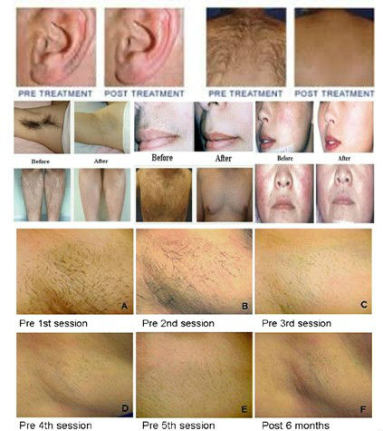 skin hair removal ipl professional 808nm laser hair removal for all skin types