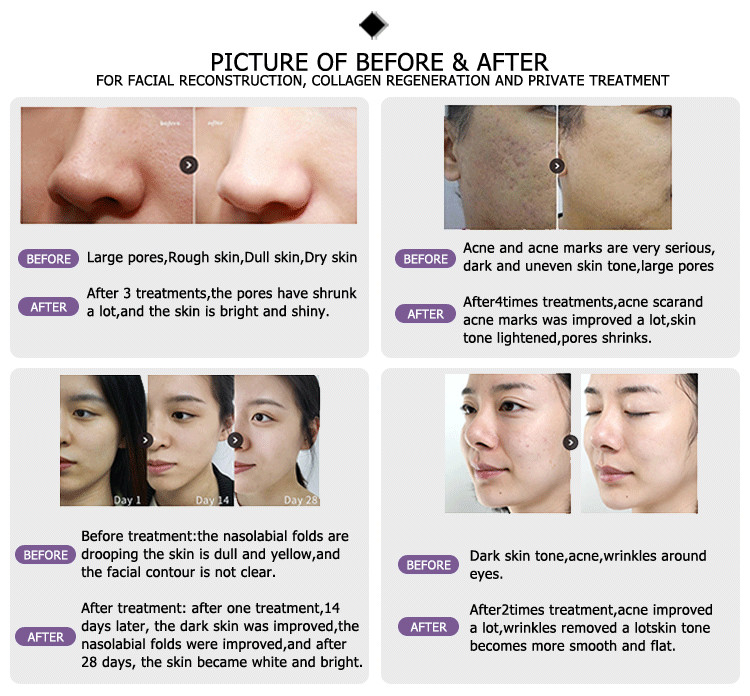 Professional hot sell collagen stimulation fractional skin tightening laser multi function machine