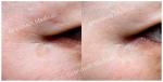 2ml Pcl Skin Booster Polycaprolactone Stimulating Skin Collagen Regeneration