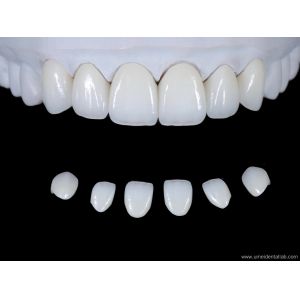 China Ultra-simulated dental zirconia aesthetic veneers wholesale