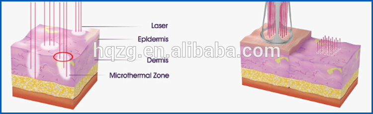 7 Scan Shapes Fractional Co2 Laser Treatment Strech Mark Removal Tighten Vagina