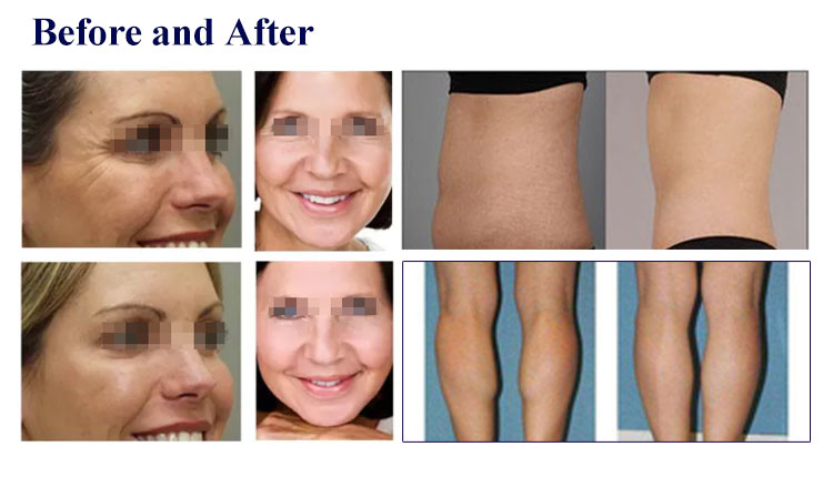 Ultrasound High Intensity Focused Ultrasound Machine 3D Anti Wrinkle Skin Tightening