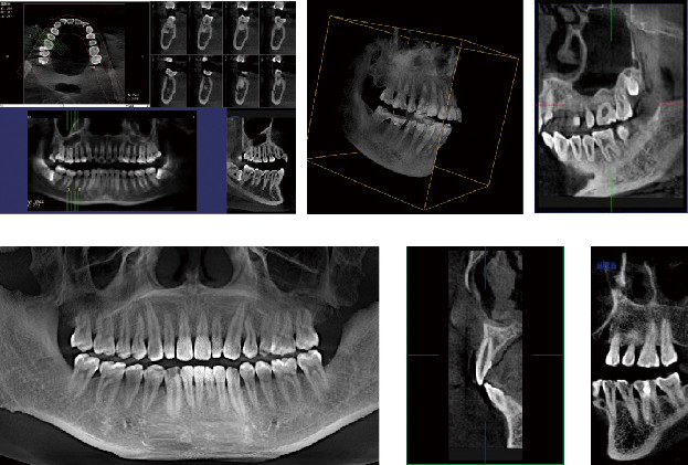 Panoramic Imaging CBCT Dental system