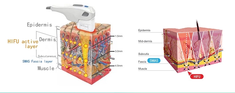 Skin tightening HIFU lifting 3d machine/11 lines 3d hifu face wrinkle removal for sale