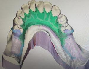 China Removable 3D Printed Partial Denture Metal Framework wholesale