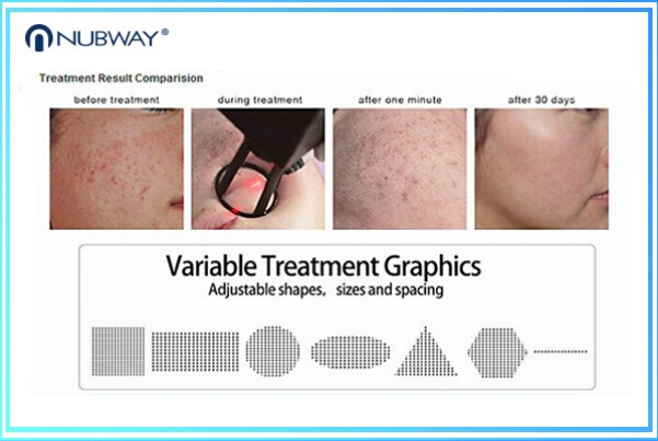 30w Fractional Co2 Laser Nubway Products Vaginal Applicator