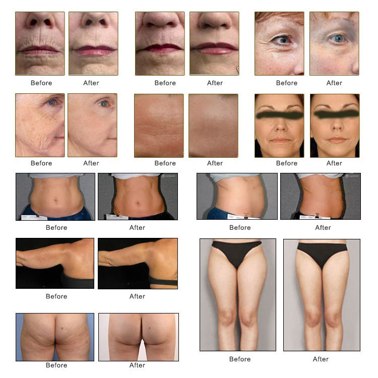 Breast Pulling 4D HIFU Anti Wrinkle Machine 12 Lines HIFU Power V Max Lift