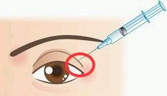 Non Cross Linked Medical Ophthalmic Sodium Hyaluronate Gel hyaluronic acid