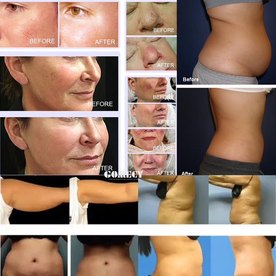 Endolift Laser Lipolysis Machine 1470nm 980nm Varicose Vein Removal Machine