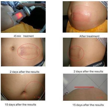 40% Off the most featured Cryolipolysis Slimming Instrument Green Vertical