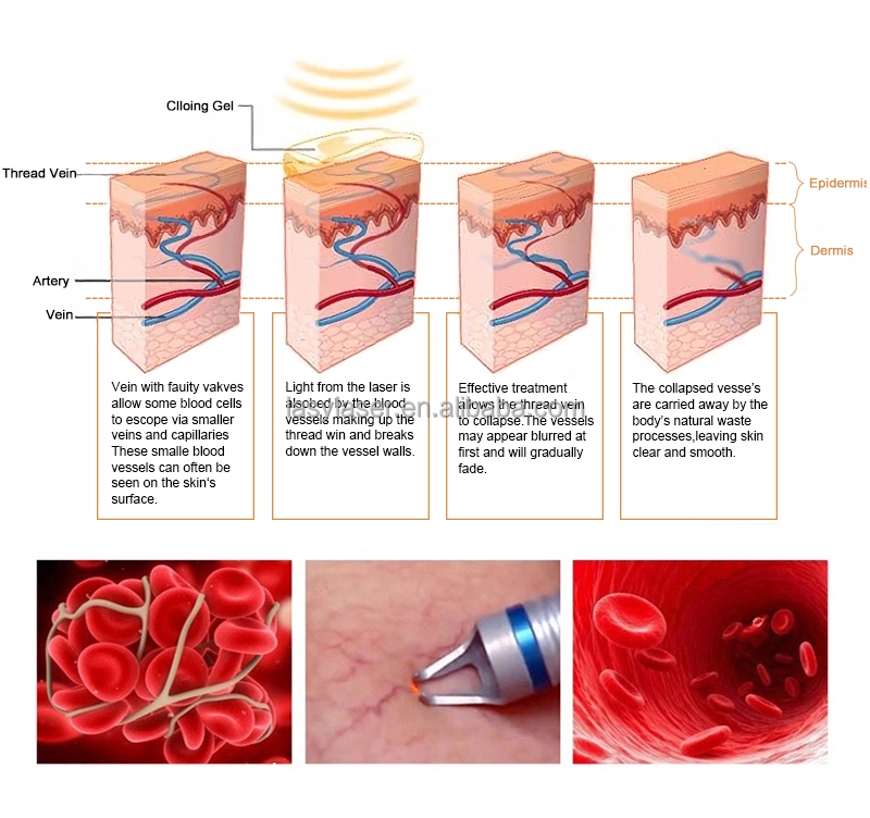 Vascular 980nm Laser Hair Tattoo Removal Machine Diode Pico Laser Machine
