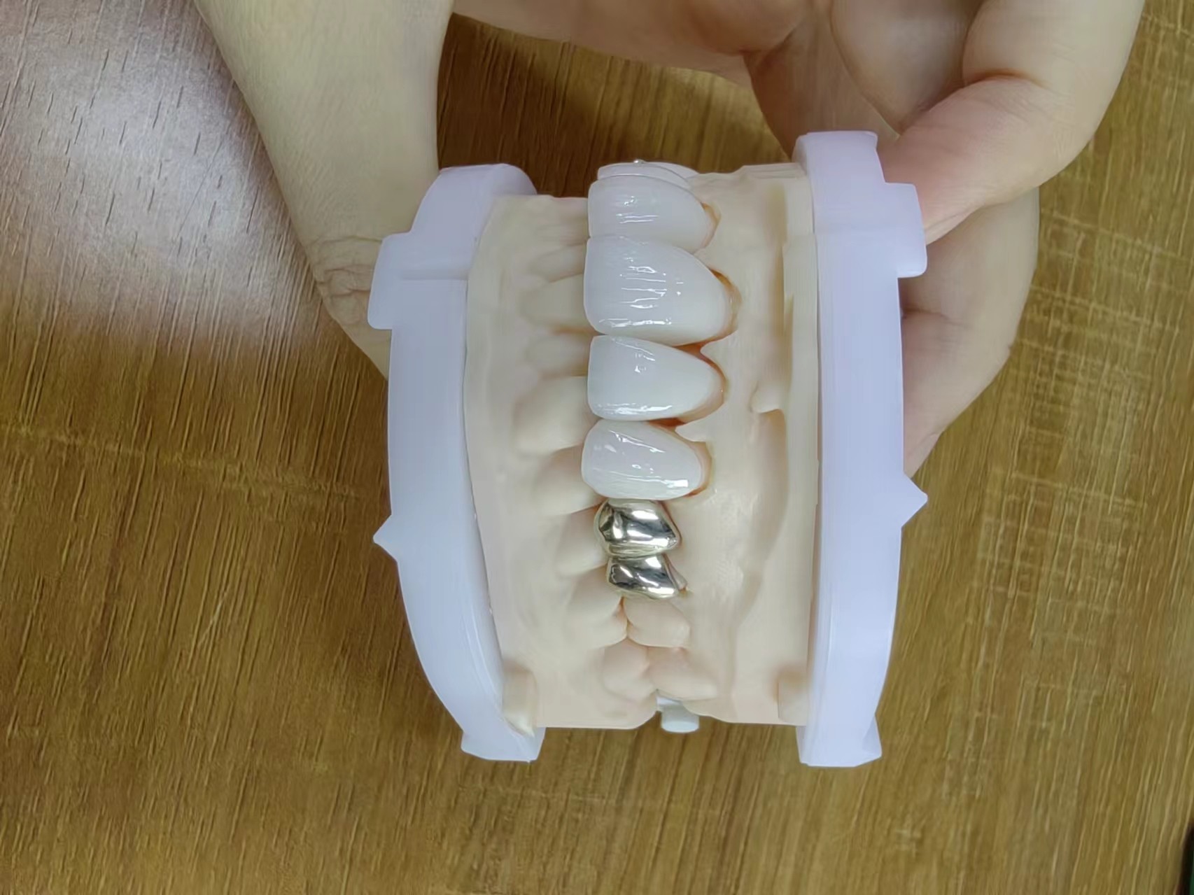 Highly Translucent Zirconia Crowns Bridge Veneers With Customized Jewelry And Gold Beautiful Dental Restoration Case