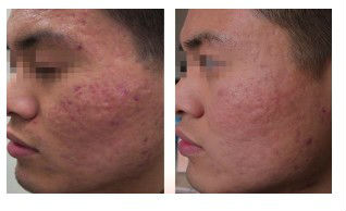 Newest factory direct sale Thermag Skin Treatment Machine