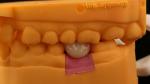 Screw Retained PFZ Porcelain Layered Zirconia Dental Implant Crown from Dental