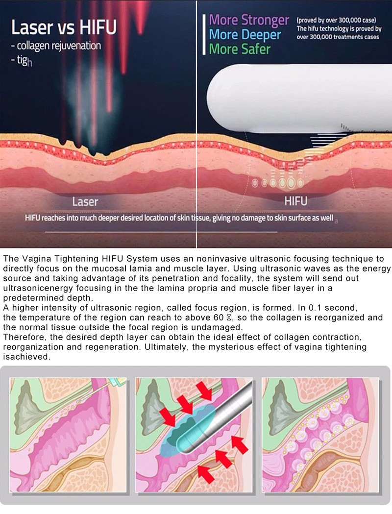 LF-432 Most effective 360 rotation firming hifu for l rejuvenation and l treatment